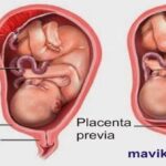 plasenta previa totalis marginalis marjinal nedir dogum yapanlar var mi