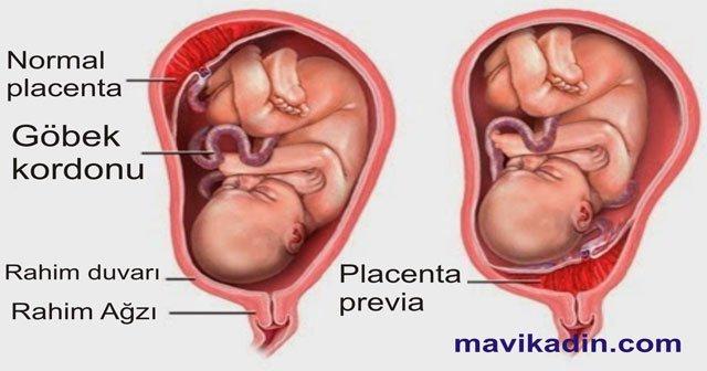 plasenta previa totalis marginalis marjinal nedir dogum yapanlar var mi