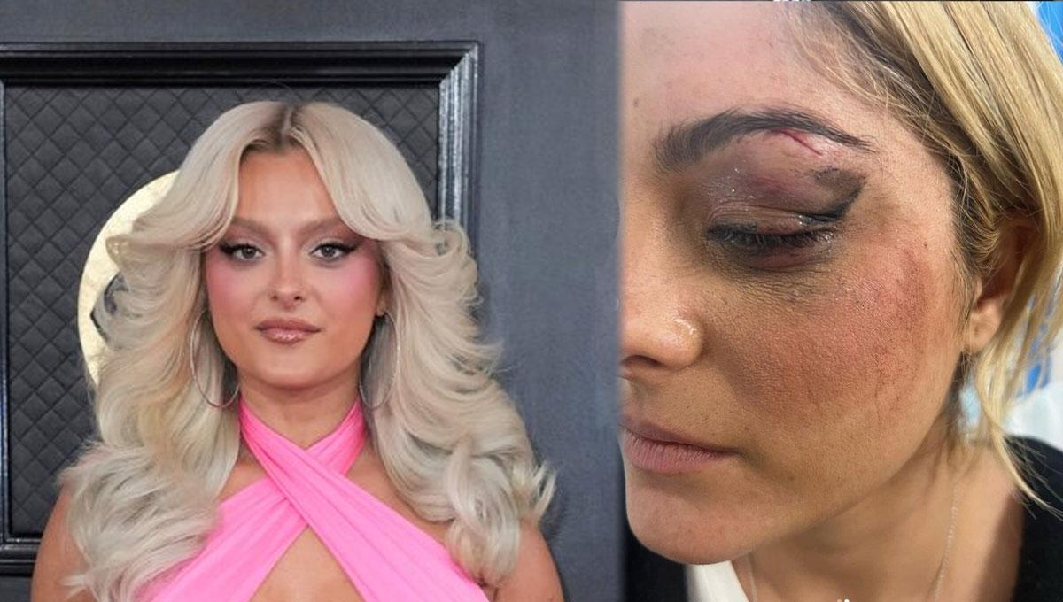 sahnede saldiriya ugrayan bebe rexha son halini paylasti kasina dikis atildi