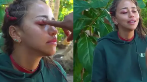 Survivor Zeynep Alkanin gozune ne oldu Tarantula isirdi gozu mosmor oldu