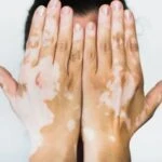 vitiligo hastalık